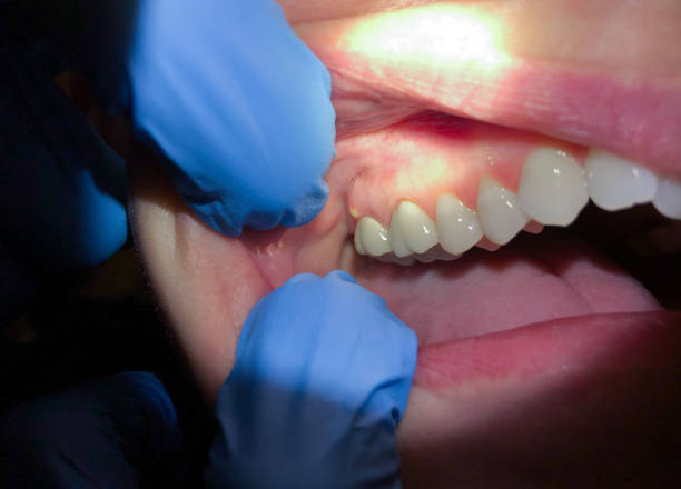 Best Emergency Tooth Extraction in Parchment, MI